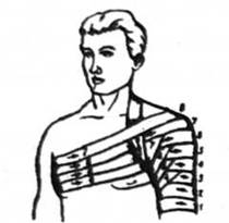 Пов'язка, накладена на ділянку плечового суглоба (цифрами позначено витки бинта) 