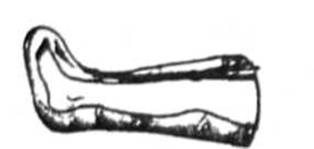 Знерухомлення кінцівки за допомогою пневма¬тичної шини при переломах гомілки і стопи
