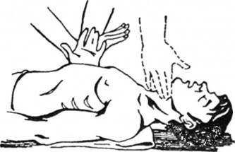 Правильне положення рук під час виконання зовнішнього масажу серця і визначенні пульсу по сонній артерії (пунктиром)