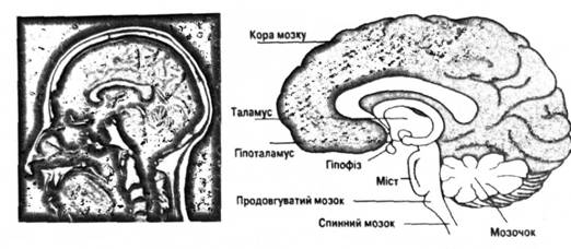 Сагітальна томограма та переріз мозку